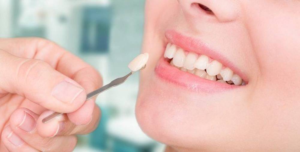 هل تتساءل عن كيفية اختيار فينير الأسنان الذي يناسبك؟